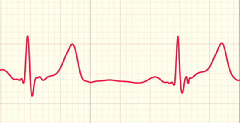 Apple Watch ile Kalp Atışı İzleme